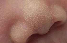 宝宝鼻子上的小白点是什么？