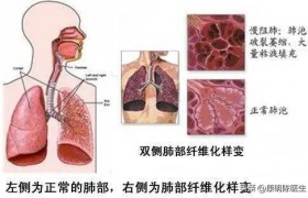 肺纤维化真的只能活3-5年吗？