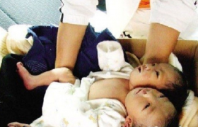 当年四川产妇诞下首例“双头女婴”，将产检医院告上了法庭